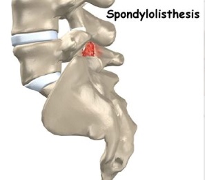 Spondylolisthesis diagram schematic