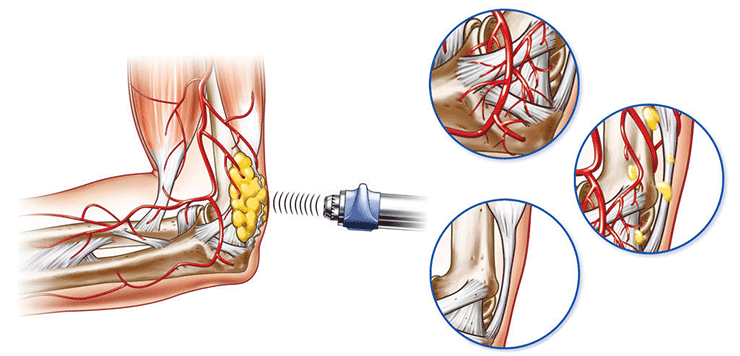Shockwave Therapy Diagram