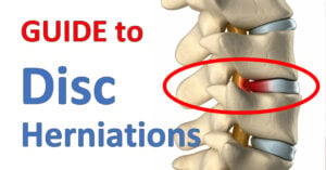 guide to lumbar spine in back showing a bulging disc herniation pinching a nerve root