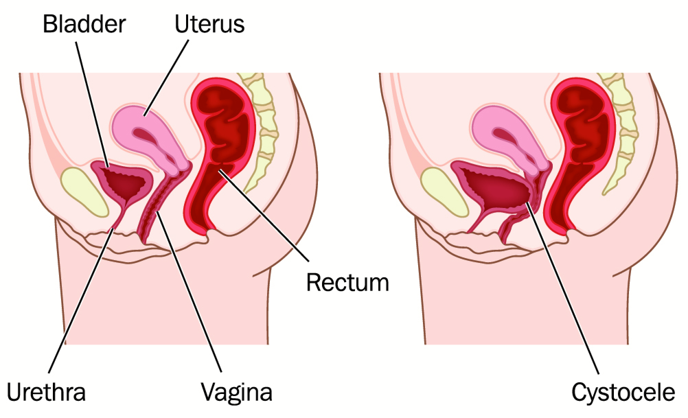 Pelvic cystocele bladder prolapse normal abnormal anatomy
