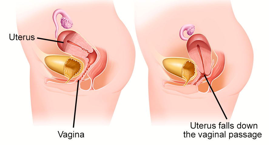 Pelvic uterine prolapse normal abnormal anatomy