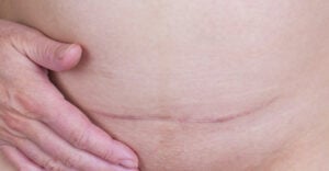 c-section cesarean scar on abdomen after delivery