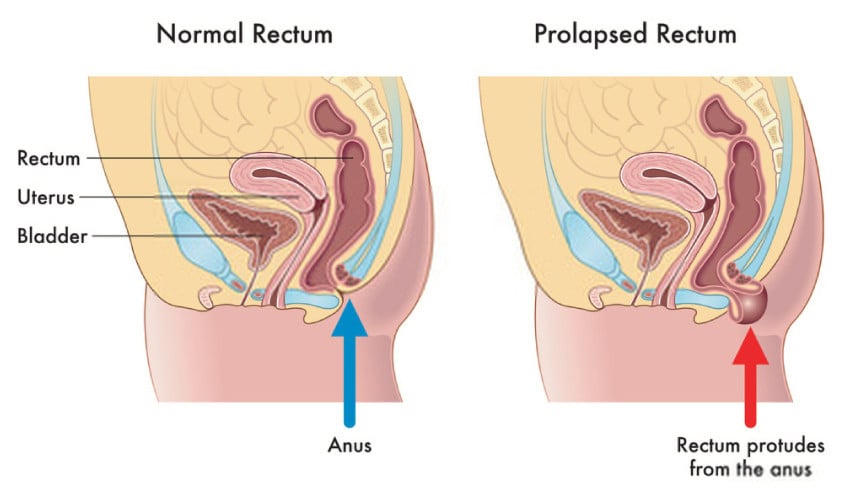 pelvic rectal prolapse anatomy normal vs abnormal