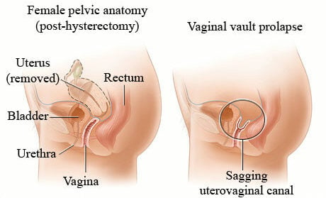 pelvic vaginal vault prolapse anatomy after hysterectomy