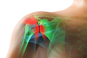 shoulder anatomy showing pain due to impingement