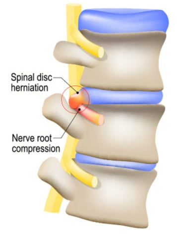 anatomy of lumbar spine in back showing a bulging disc herniation pinching a nerve root