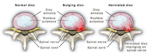 anatomy showing normal lumbar spine disc, bulging disc, and herniated disc